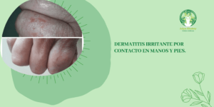 Lee más sobre el artículo TRATAMIENTO DERMATITIS IRRITANTE POR CONTACTO