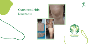 Lee más sobre el artículo Tratamiento en Paciente con Osteocodritis Disecante